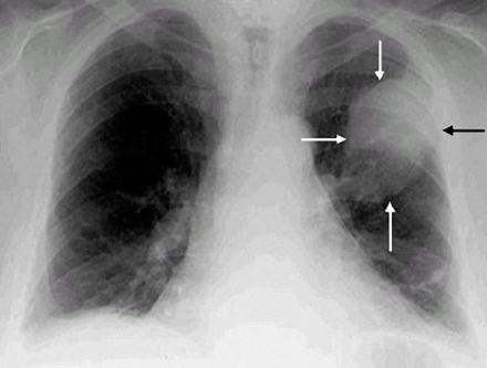 Оновлені гайдлайни щодо скринінгу раку легень