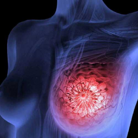 Асоціація індексу маси тіла та ризику вторинного раку у тих, хто пережив рак молочної залози