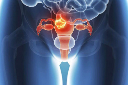 Рак шийки матки (РШМ) у вагітних